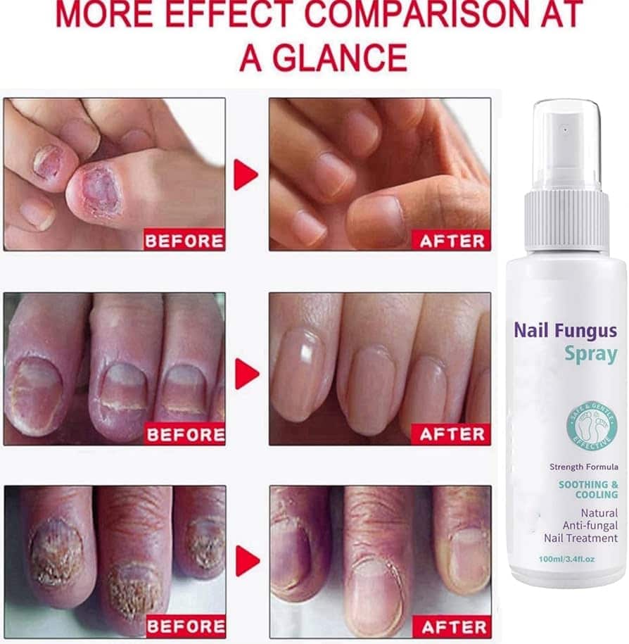 Jaysuin - Nail Fungus Spray